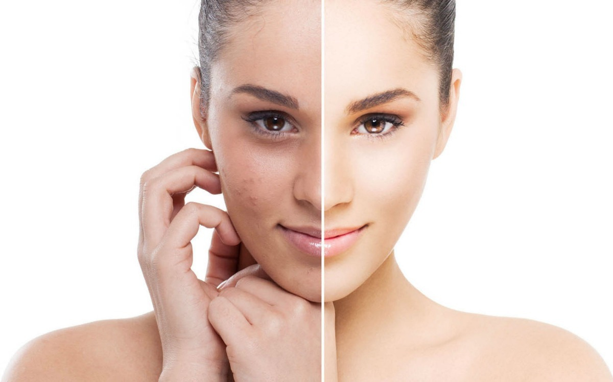 Acido Lactobionico 10 % Ph 3.5 Renovacion Antiage Idraet - Image 3